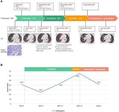 Case Report: Short-Term Response to First-Line Crizotinib Monotherapy in a Metastatic Lung Adenocarcinoma Patient Harboring a Novel TPR-ROS1 Fusion